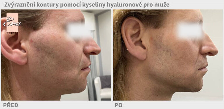 Kyselina hyaluronová pro muže